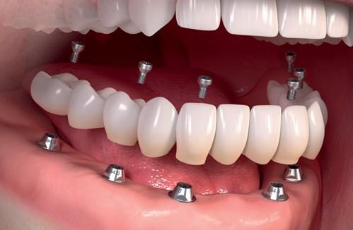 Dental Implant in Mississauga