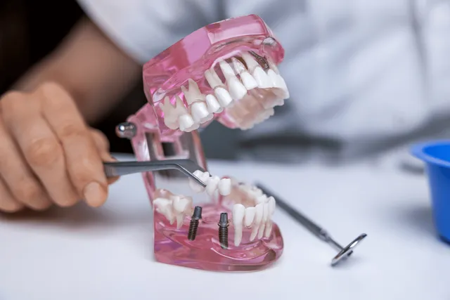 Dental Bridge in Mississauga