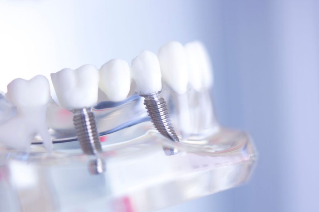 Dental Bridge in Mississauga