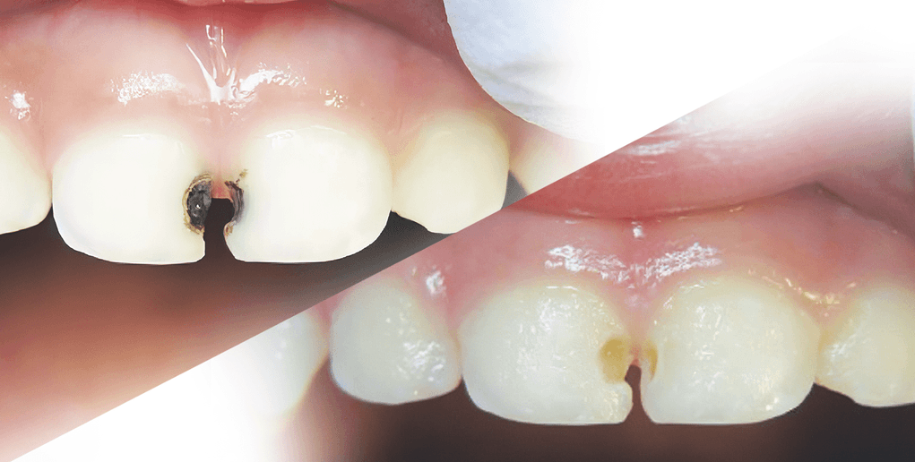 Fluortide Treatment in Mississauga