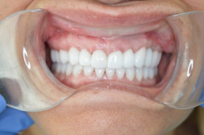 Full Mouth Reconstruction in Mississauga