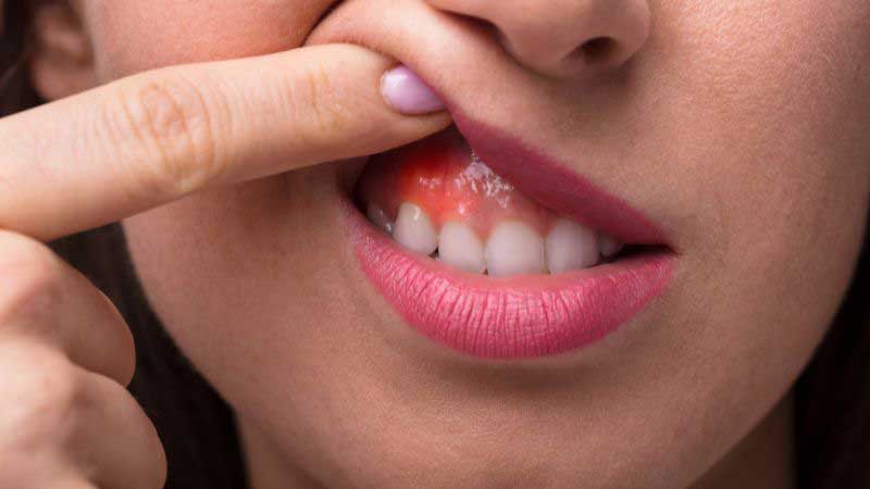 Teeth Cleaning in Mississauga