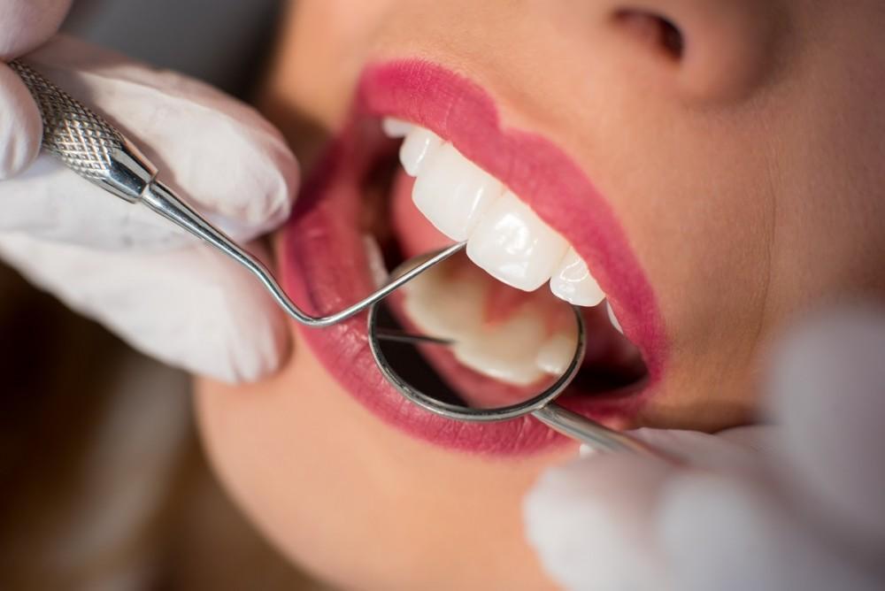 Teeth Cleaning in Mississauga