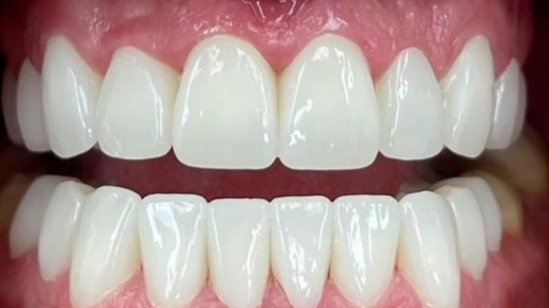 Invisalign Clear Aligner Result in Mississauga