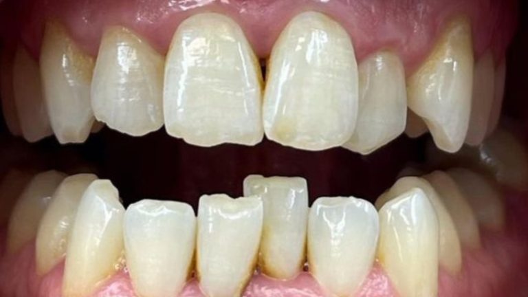 Invisalign Before