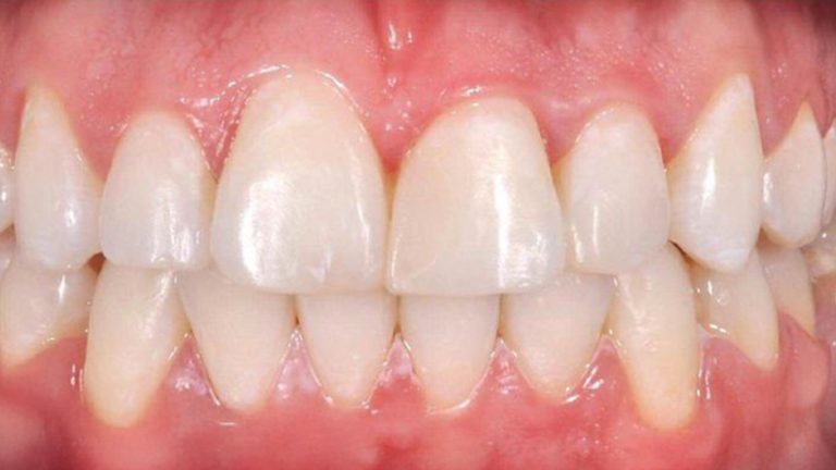 Invisalign Result in Mississauga