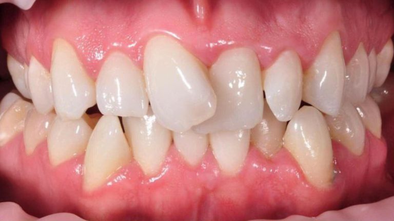 Invisalign Before