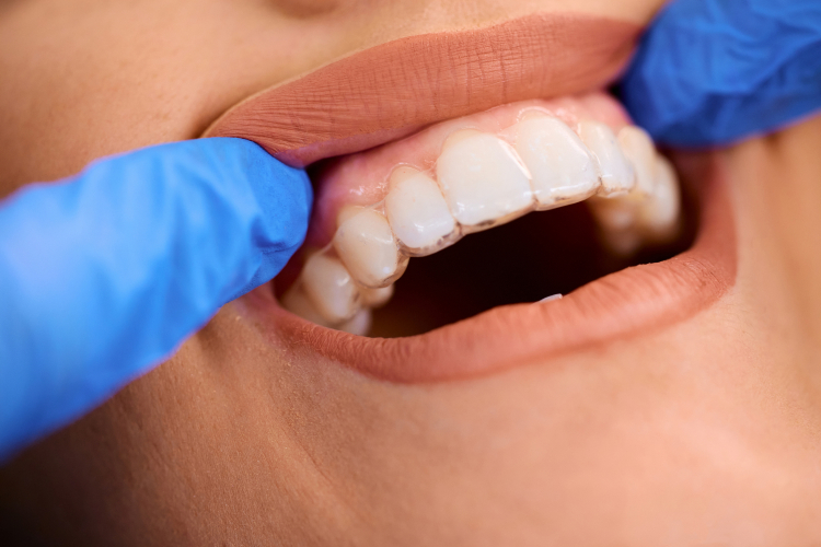 Invisalign in Mississauga