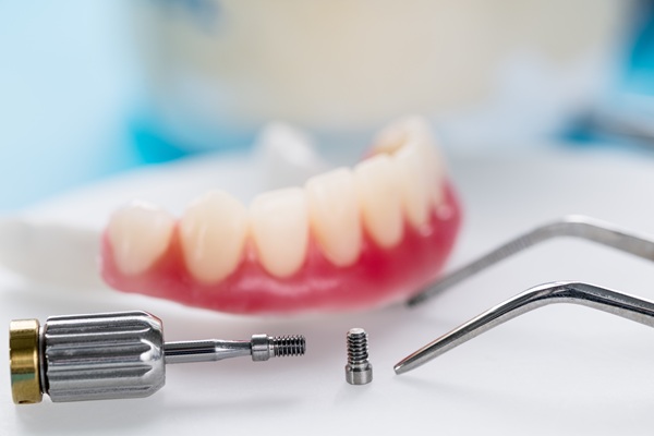 Dental Implant in Mississauga