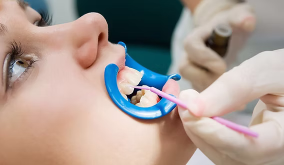 Fluortide Treatment in Mississauga