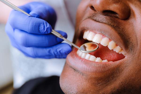 Dental Sealants in Mississauga
