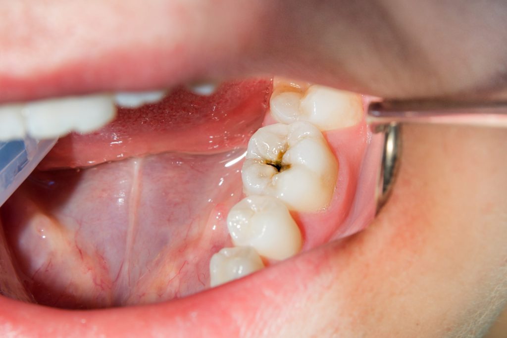 Dental Sealants in Mississauga