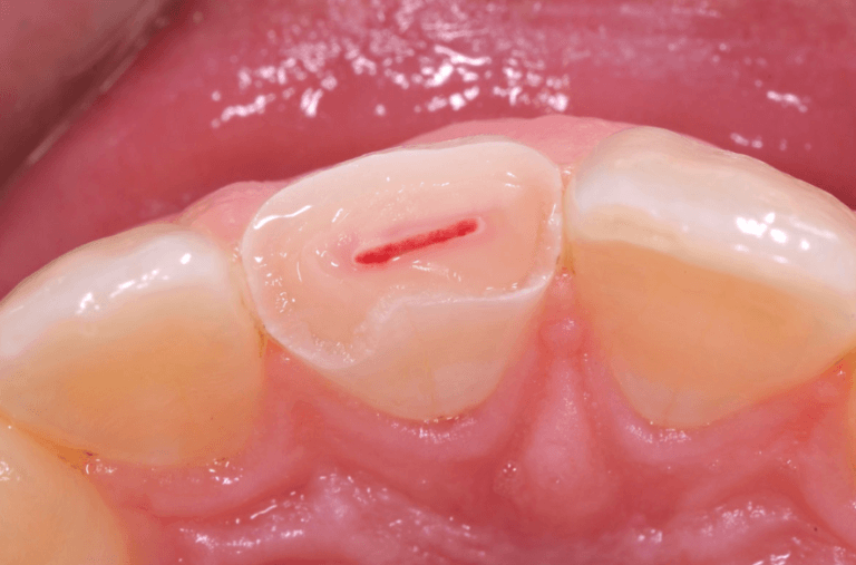 dental-pulp-capping-768x507-1